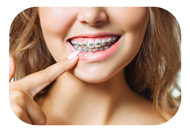 Invisalign vs Braces: Which is Better For You? - Antalya Dental Clinic